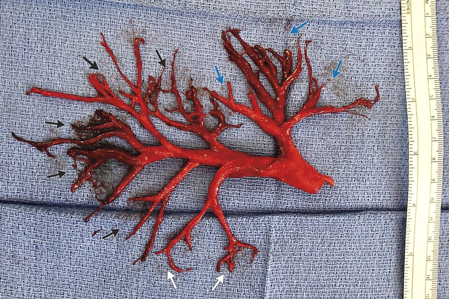 Check Out This Massive Intact Blood Clot Someone Coughed Up